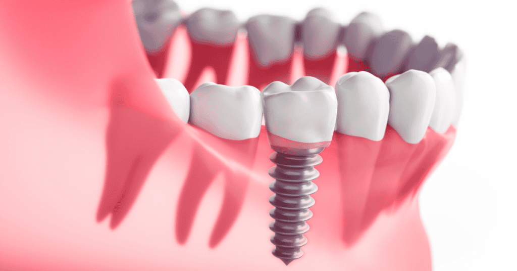 Porcelain veneer smile transformation